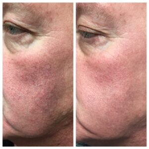 Facial redness treatment for men at Dr. Minuk's SkinClinic & Laser Centre