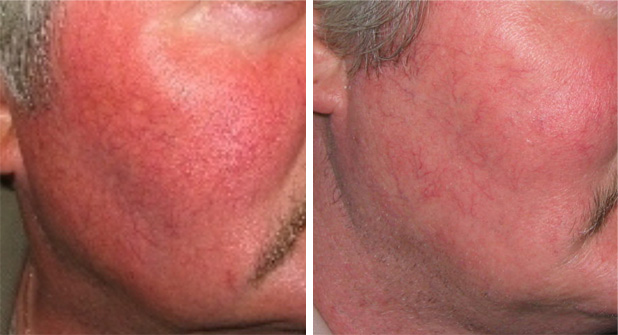 Facial redness treatment for men at Dr. Minuk's SkinClinic & Laser Centre